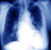 Mesothelioma Lung Cancer